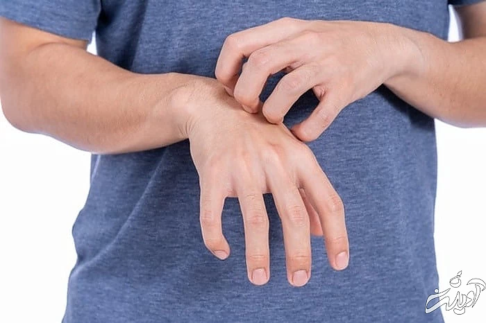 خارش پوست کلیه